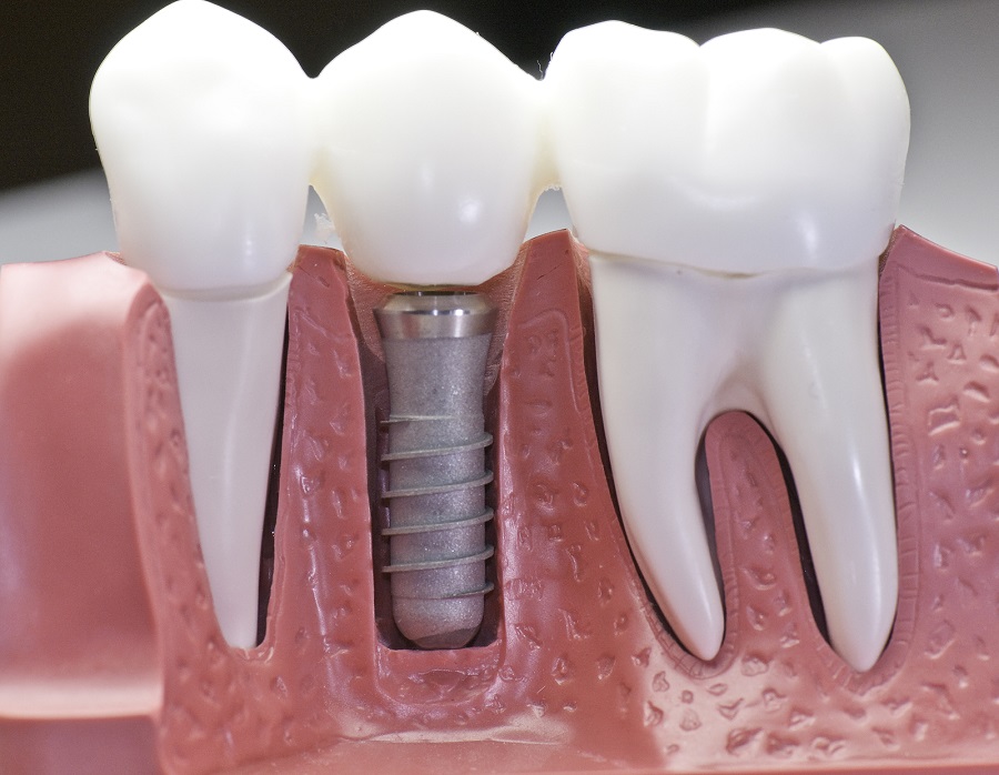 Dental Implants Are a Solution to Replacing Lost Teeth