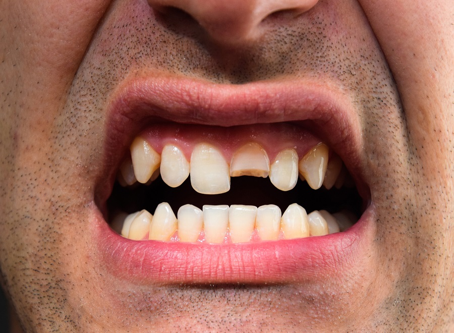 Inconsistent Oral Hygiene Could Result in the Need For a Dental Filling