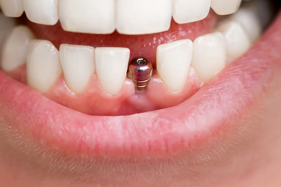 Dental Implant Placement Basics as a Step-by-Step Process